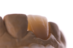 Pr贸tesis dental Fija