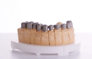 Prótesis dental fija