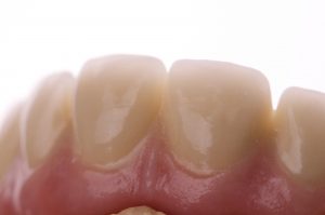 Prótesis dental fija