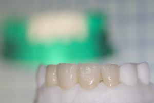 Prótesis dental fija