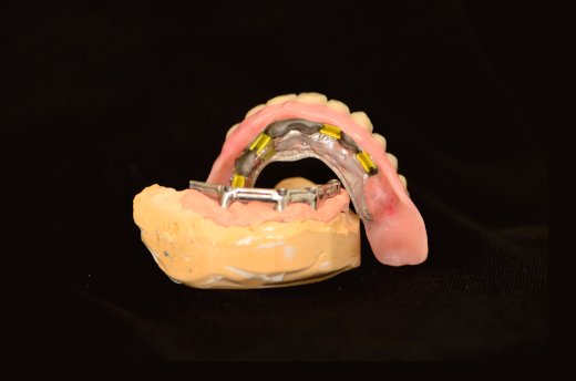 Implantes tipo barras