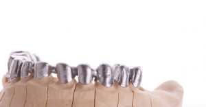 Prótesis dental fija