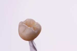 Prótesis dental fija
